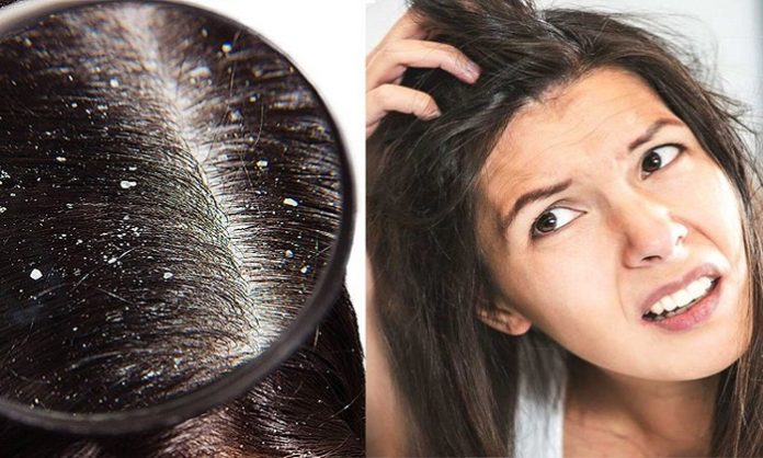 Embarrassed due to dandruff, then follow these home remedies