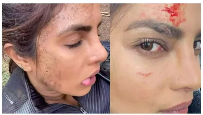Priyanka Chopra On Injured Eye Brow: Priyanka Chopra does not want to hide the mark on her eyebrow, know how she got this injury